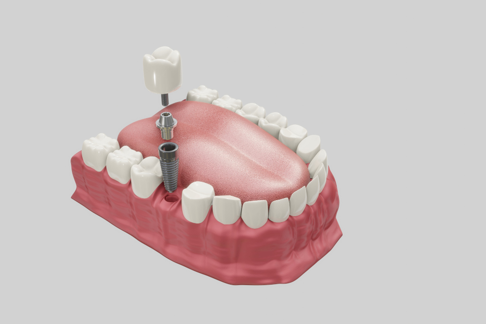 Dental Implants near me