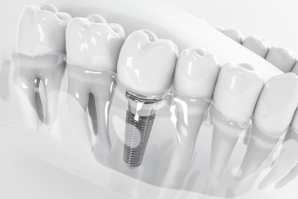 Dental implants Hurst