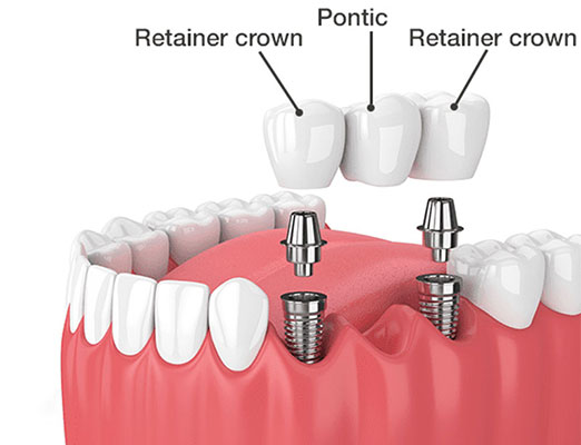 Hurst Dental implants