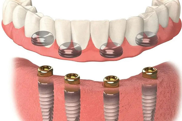 Hurst Implant Dentistry