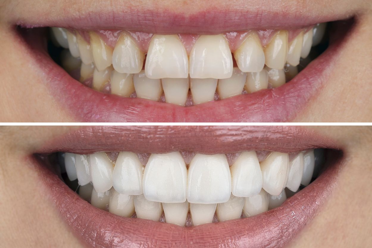 Dental Veneers